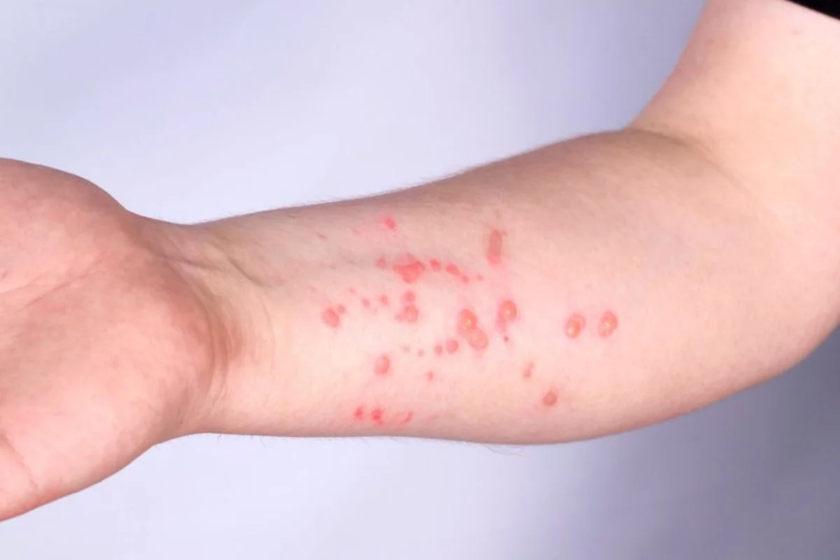 Dois casos de Mpox são confirmados no Rio Grande do Norte